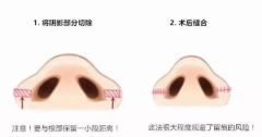 鼻翼縮小——打造鼻部精致的翅膀